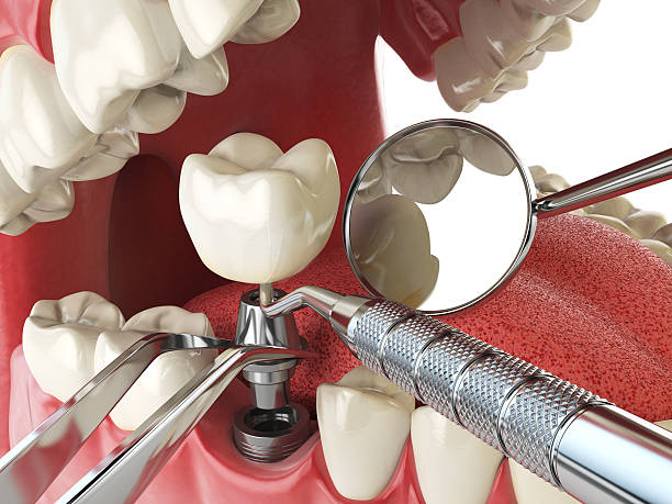 Best Emergency Root Canal Treatment in Caoncito, NM